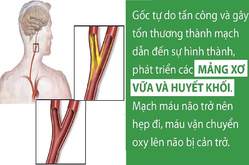 Đột quỵ và tai biến mạch máu não: tuy hai mà một