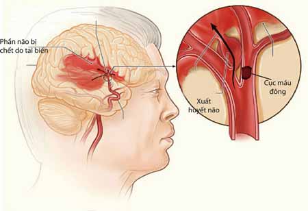 Xuất huyết não: Nguyên nhân và triệu chứng