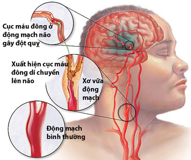 Phòng ngừa đột quỵ ở người trẻ thanh niên