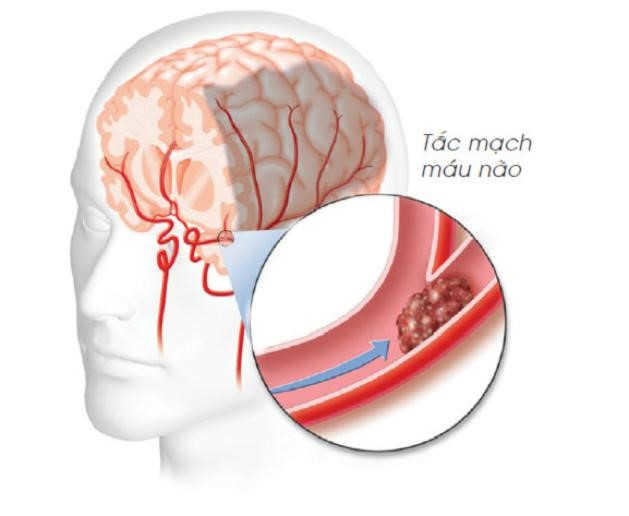 Thiếu máu não uống thuốc gì hiệu quả?