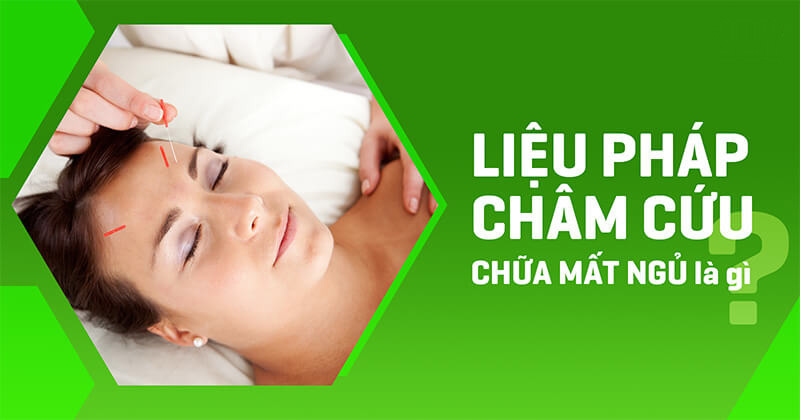 châm cứu chữa mất ngủ