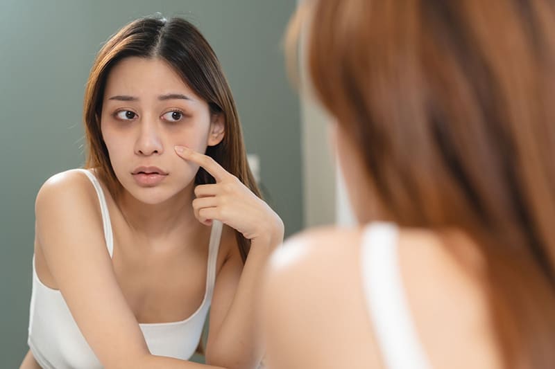 quầng thâm dưới mắt