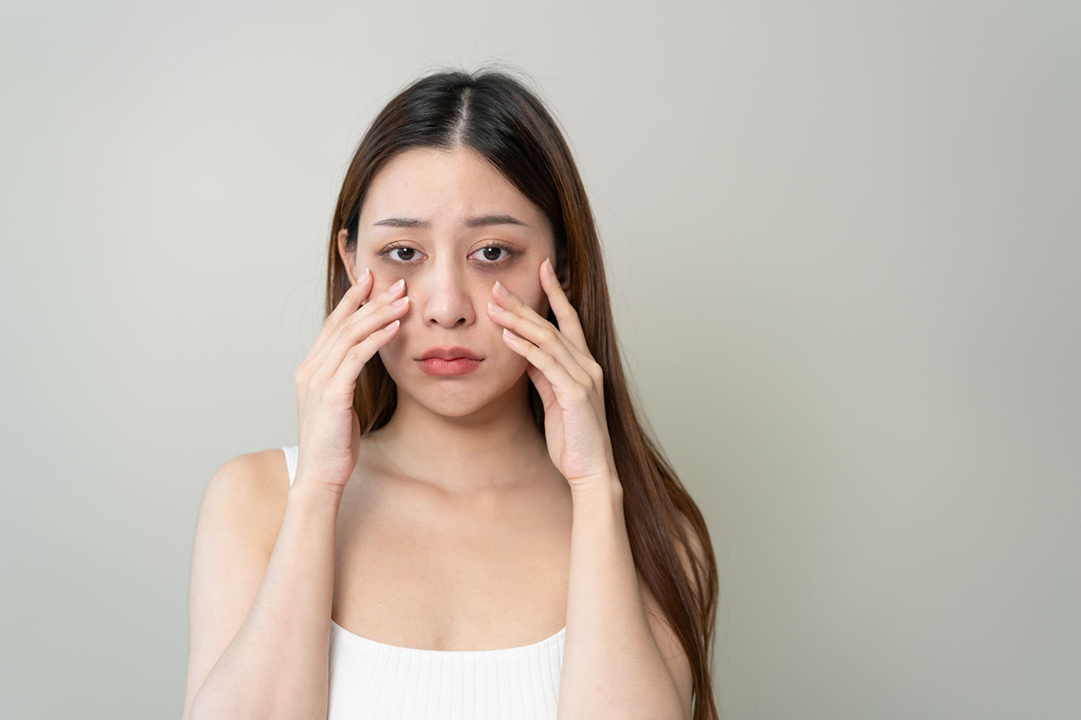 thâm mắt có thể do di truyền, thiếu dinh dưỡng hoặc căng thẳng